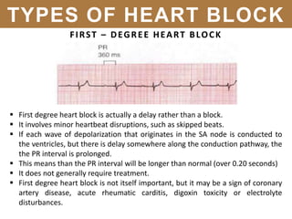 FIRST – DEGREE HEART BLOCK
 First degree heart block is actually a delay rather than a block.
 It involves minor heartbeat disruptions, such as skipped beats.
 If each wave of depolarization that originates in the SA node is conducted to
the ventricles, but there is delay somewhere along the conduction pathway, the
the PR interval is prolonged.
 This means than the PR interval will be longer than normal (over 0.20 seconds)
 It does not generally require treatment.
 First degree heart block is not itself important, but it may be a sign of coronary
artery disease, acute rheumatic carditis, digoxin toxicity or electrolyte
disturbances.
TYPES OF HEART BLOCK
 