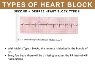 SECOND – DEGREE HEART BLOCK TYPE II
 With Mobitz Type II blocks, the impulse is blocked in the bundle of
His
 Every few beats there will be a missing beat but the PR interval will
not lengthen
TYPES OF HEART BLOCK
 