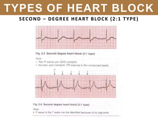 SECOND – DEGREE HEART BLOCK (2:1 TYPE)
TYPES OF HEART BLOCK
 