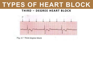 THIRD – DEGREE HEART BLOCK
TYPES OF HEART BLOCK
 
