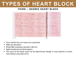 THIRD – DEGREE HEART BLOCK
TYPES OF HEART BLOCK
 Sinus rhythm but no P waves are conducted
 Right axis deviation
 Broad QRS complexes (duration 160 ms)
 Right bundle branch block pattern
 The cause of the block could not be determined, though in most patients it results
from fibrosis of bundle of His
 