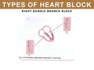 RIGHT BUNDLE BRANCH BLOCK
TYPES OF HEART BLOCK
 
