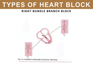 RIGHT BUNDLE BRANCH BLOCK
TYPES OF HEART BLOCK
 