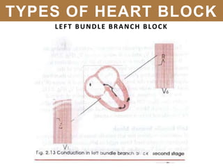 LEFT BUNDLE BRANCH BLOCK
TYPES OF HEART BLOCK
 