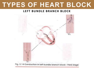 LEFT BUNDLE BRANCH BLOCK
TYPES OF HEART BLOCK
 