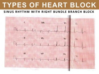 SINUS RHYTHM WITH RIGHT BUNDLE BRANCH BLOCK
TYPES OF HEART BLOCK
 