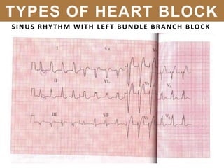 SINUS RHYTHM WITH LEFT BUNDLE BRANCH BLOCK
TYPES OF HEART BLOCK
 