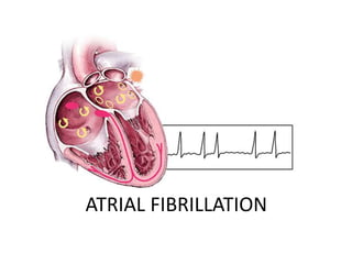 ATRIAL FIBRILLATION
 