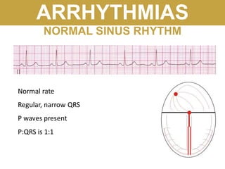 ARRHYTHMIAS
NORMAL SINUS RHYTHM
 