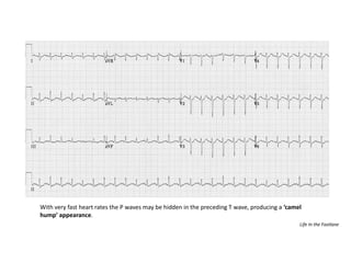 With very fast heart rates the P waves may be hidden in the preceding T wave, producing a ‘camel
hump’ appearance.
Life In the Fastlane
 