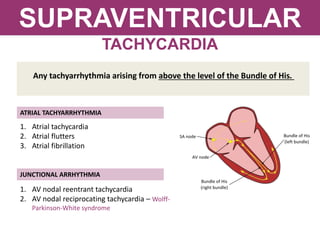 SUPRAVENTRICULAR
TACHYCARDIA
Any tachyarrhythmia arising from above the level of the Bundle of His.
ATRIAL TACHYARRHYTHMIA
JUNCTIONAL ARRHYTHMIA
1. Atrial tachycardia
2. Atrial flutters
3. Atrial fibrillation
1. AV nodal reentrant tachycardia
2. AV nodal reciprocating tachycardia – Wolff-
Parkinson-White syndrome
 
