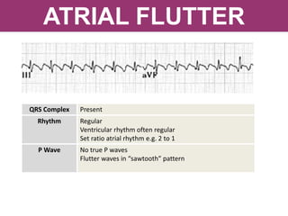 ATRIAL FLUTTER
QRS Complex Present
Rhythm Regular
Ventricular rhythm often regular
Set ratio atrial rhythm e.g. 2 to 1
P Wave No true P waves
Flutter waves in “sawtooth” pattern
 