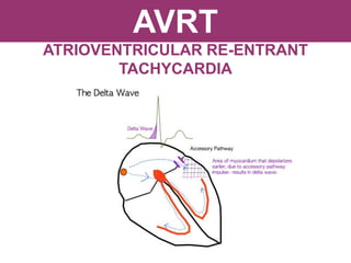 AVRT
ATRIOVENTRICULAR RE-ENTRANT
TACHYCARDIA
 