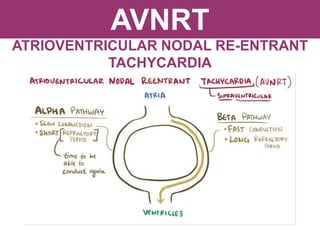 AVNRT
ATRIOVENTRICULAR NODAL RE-ENTRANT
TACHYCARDIA
 