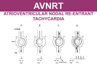AVNRT
ATRIOVENTRICULAR NODAL RE-ENTRANT
TACHYCARDIA
 