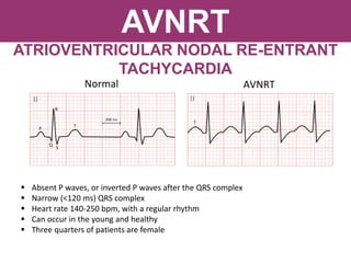 AVNRT
ATRIOVENTRICULAR NODAL RE-ENTRANT
TACHYCARDIA
 Absent P waves, or inverted P waves after the QRS complex
 Narrow (<120 ms) QRS complex
 Heart rate 140-250 bpm, with a regular rhythm
 Can occur in the young and healthy
 Three quarters of patients are female
 