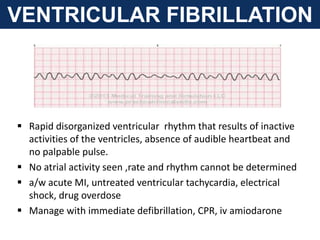 VENTRICULAR FIBRILLATION
 Rapid disorganized ventricular rhythm that results of inactive
activities of the ventricles, absence of audible heartbeat and
no palpable pulse.
 No atrial activity seen ,rate and rhythm cannot be determined
 a/w acute MI, untreated ventricular tachycardia, electrical
shock, drug overdose
 Manage with immediate defibrillation, CPR, iv amiodarone
 