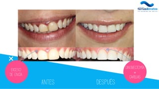 Antes Después
Exceso
De encía
Gingivectomía
+
carillas
 