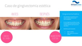  Esta indicada en pacientes que al
sonreír enseñan mucha encía
(sonrisa gingival).
 Es una cirugía muy sencilla en la que
se contornea la forma de la encía con
un bisturí eléctrico para que se vea
más diente
 Beneficios para el paciente
 Mejora estética
 Mejor ajuste de coronas o
carillas
Gingivectomía Estética
Caso de gingivectomía estética
Antes Después
Exceso
De encía
Gingivectomía
estética
 