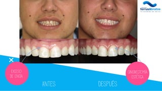 Antes Después
Exceso
De encía
Gingivectomía
estética
 