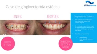  Esta indicada en pacientes que al
sonreír enseñan mucha encía
(sonrisa gingival).
 Es una cirugía muy sencilla en la que
se contornea la forma de la encía con
un bisturí eléctrico para que se vea
más diente
 Beneficios para el paciente
 Mejora estética
 Mejor ajuste de coronas o
carillas
Gingivectomía Estética
Caso de gingivectomía estética
Antes Después
Exceso
De encía
Gingivectomía
Estética +
carillas
 