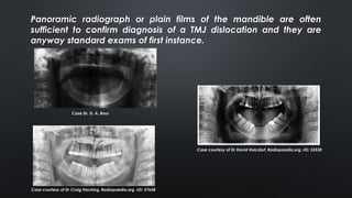 Panoramic radiograph or plain films of the mandible are often
sufficient to confirm diagnosis of a TMJ dislocation and they are
anyway standard exams of first instance.
Case Dr. D. A. Baur
Case courtesy of Dr David Holcdorf, Radiopaedia.org, rID: 53530
Case courtesy of Dr Craig Hacking, Radiopaedia.org, rID: 57658
 