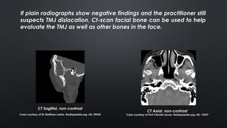 If plain radiographs show negative findings and the practitioner still
suspects TMJ dislocation, Ct-scan facial bone can be used to help
evaluate the TMJ as well as other bones in the face.
CT Sagittal, non-contrast
Case courtesy of Dr Matthew Lukies, Radiopaedia.org, rID: 59430
CT Axial, non-contrast
Case courtesy of Prof Cláudio Souza, Radiopaedia.org, rID: 13947
 