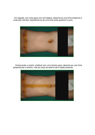 Em seguida, com outra gaze com anti-séptico, desenha-se uma linha tangencia a
união dos mamilos, estendendo-se de uma linha axilar posterior à outra.




  Contornando a cicatriz umbilical com uma terceira gaze, desenha-se uma linha
perpendicular à anterior, indo do corpo do esterno até a região pudenda.
 