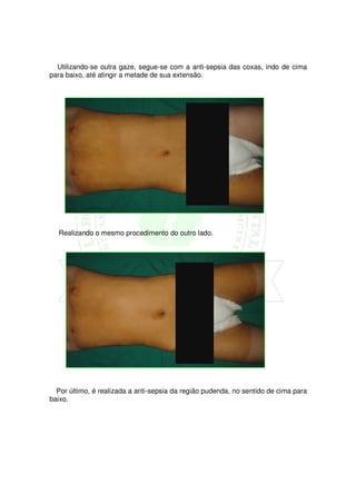 Utilizando-se outra gaze, segue-se com a anti-sepsia das coxas, indo de cima
para baixo, até atingir a metade de sua extensão.




  Realizando o mesmo procedimento do outro lado.




  Por último, é realizada a anti-sepsia da região pudenda, no sentido de cima para
baixo.
 