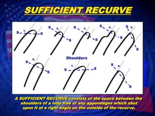 SUFFICIENT RECURVESSSS4.5.2.3.1.SSSSSSShoulders6.SS8.7.SSSSA SUFFICIENT RECURVE consists of the space between the shoulders of a loop free of any appendages which abutupon it at a right angle on the outside of the recurve.