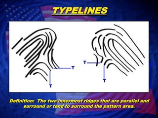 TYPELINESTTTTDefinition:  The two innermost ridges that are parallel and surround or tend to surround the pattern area.