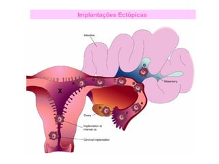 Implantações Ectópicas
 