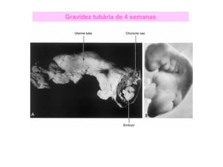 Gravidez tubária de 4 semanas
 