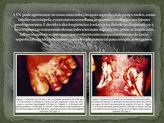 A FN  pode apresentar-se como uma infecção mais superficial de partes moles, como celulite ou erisipela, e com outras semelhanças quanto à etiologia e aos fatores predisponentes. E devido à alta freqüência e à relativa facilidade no diagnóstico e à boa resposta ao tratamento dessas infecções mais superficiais, pode-se implica em falhas terapêuticas nos casos que evoluem com comprometimento da fáscia superficial e tecido subcutâneo, com elevado potencial para complicações graves.  