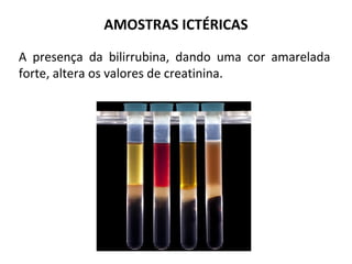 A presença da bilirrubina, dando uma cor amarelada
forte, altera os valores de creatinina.
AMOSTRAS ICTÉRICAS
 