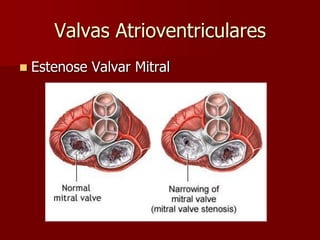 Valvas Atrioventriculares
 Estenose Valvar Mitral
 