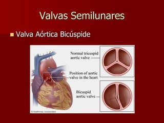 Valvas Semilunares
 Valva Aórtica Bicúspide
 