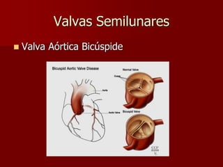  Valva Aórtica Bicúspide
Valvas Semilunares
 
