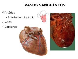  Artérias
 Infarto do miocárdio
 Veias
 Capilares
VASOS SANGUÍNEOS
 