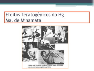 Efeitos Teratogênicos do Hg
Mal de Minamata
 