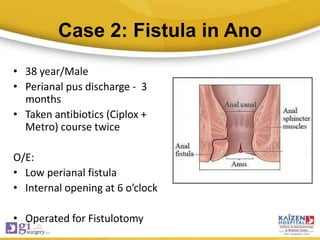 Case 2: Fistula in Ano
• 38 year/Male
• Perianal pus discharge - 3
months
• Taken antibiotics (Ciplox +
Metro) course twice
O/E:
• Low perianal fistula
• Internal opening at 6 o’clock
• Operated for Fistulotomy
 