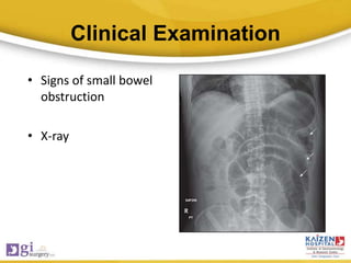 Clinical Examination
• Signs of small bowel
obstruction
• X-ray
 