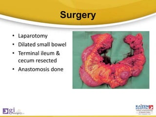 Surgery
• Laparotomy
• Dilated small bowel
• Terminal ileum &
cecum resected
• Anastomosis done
 