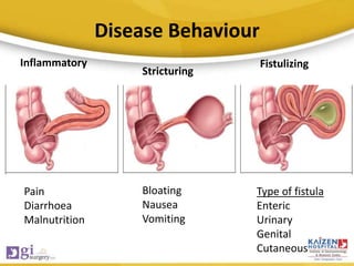 Disease Behaviour
Pain
Diarrhoea
Malnutrition
Bloating
Nausea
Vomiting
Type of fistula
Enteric
Urinary
Genital
Cutaneous
Inflammatory
Stricturing
Fistulizing
 