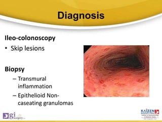 Diagnosis
Ileo-colonoscopy
• Skip lesions
Biopsy
– Transmural
inflammation
– Epithelioid Non-
caseating granulomas
 
