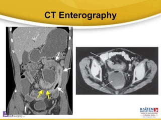 CT Enterography
 