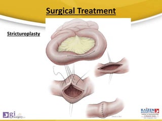 Surgical Treatment
Stricturoplasty
 