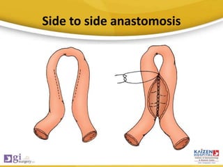 Side to side anastomosis
 