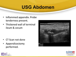 USG Abdomen
• Inflammed appendix. Probe
tenderness present.
• Thickened wall of terminal
ileum & cecum
• CT Scan not done
• Appendicectomy
performed.
 