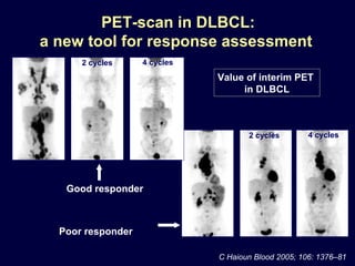 .. .. .. PET-scan in DLBCL: a new tool for response assessment  Value of interim PET  in DLBCL Poor responder 2 cycles 2 cycles 4 cycles 4 cycles C  Haioun Blood 2005; 106: 1376–81  Good responder 